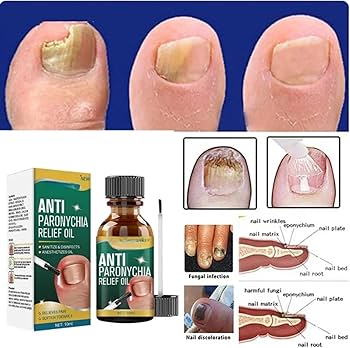 Anti Paronychia Relief Oil